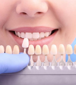 Tooth Coloured Fillings
